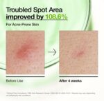 Anua Azelaic Acid 10 Hyaluronic Redness Soothing Serum, Facial Serum for Sensitive Skin, Hyaluronic Acid, Niacinamide, Spot Care, Natural Colour, Vegan, Korean Skincare (30 ml / 1.01 fl oz.) - Image 4